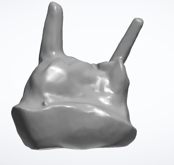 CÙI GIẢ SỨ ZIRCONIA