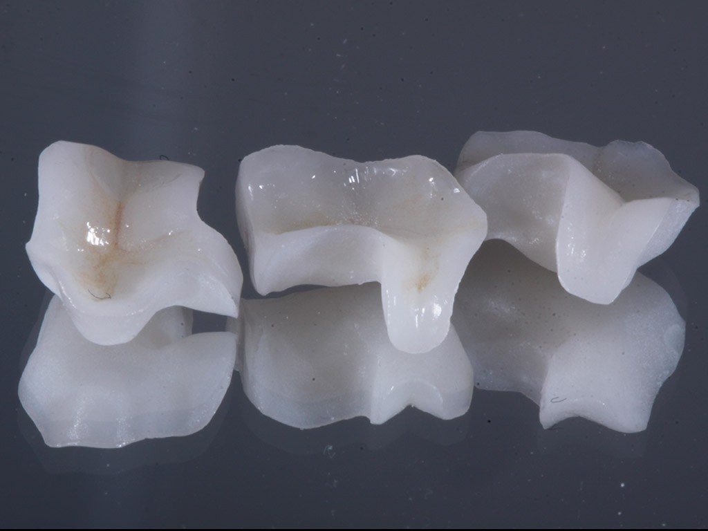 INLAY / ONLAY ZIRCONIA
